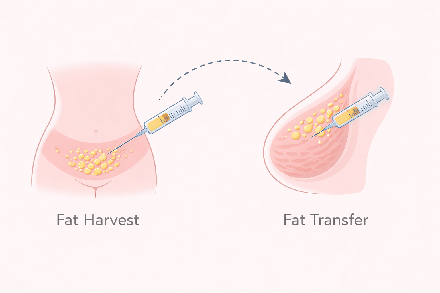 Fat grafting breast augmentation natural results