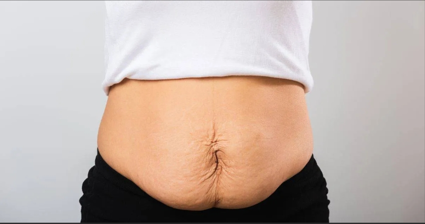 Tummy tuck Malaysia
